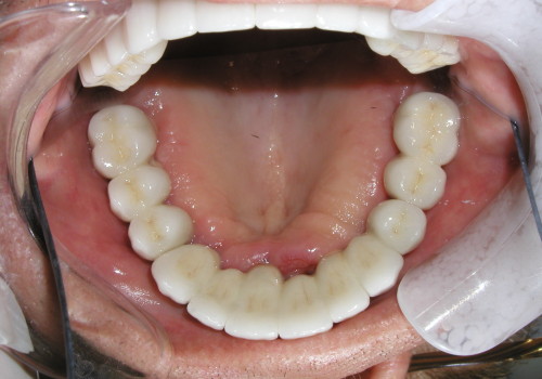 Entire jaw of Dental Implants photo