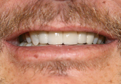 Close up of smile after implants and crowns