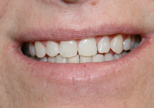 Closeup photo of short gapped teeth before cosmetics